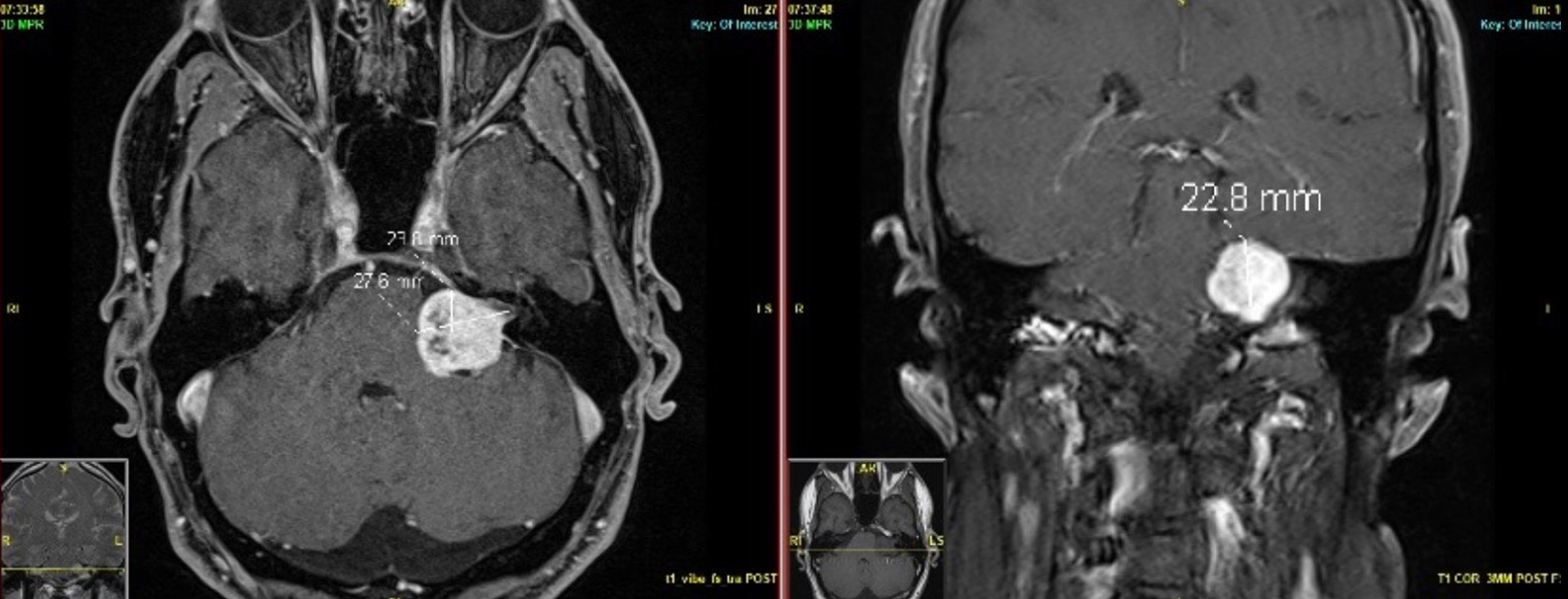Joe's tumor MRI